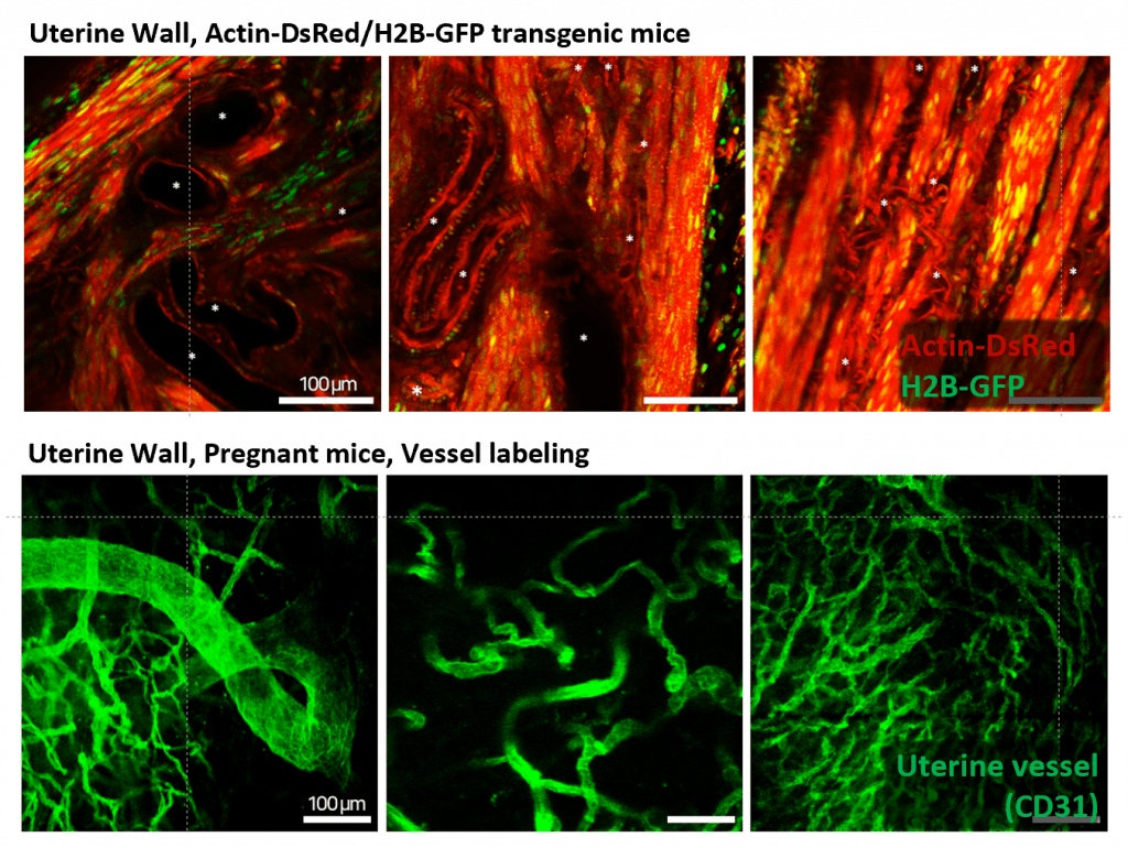 IVIM Technology featuring with Tissue Motion Stabiliser (TMS) - uterine wall imaging